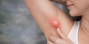 Koltuk Altındaki Şişlik Her Zaman Masum Değil: Ektopik Meme Dokusu Uyarısı