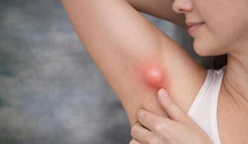 Koltuk Altındaki Şişlik Her Zaman Masum Değil: Ektopik Meme Dokusu Uyarısı