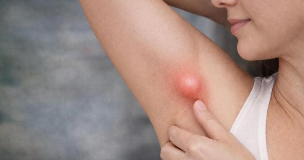 Koltuk Altındaki Şişlik Her Zaman Masum Değil: Ektopik Meme Dokusu Uyarısı